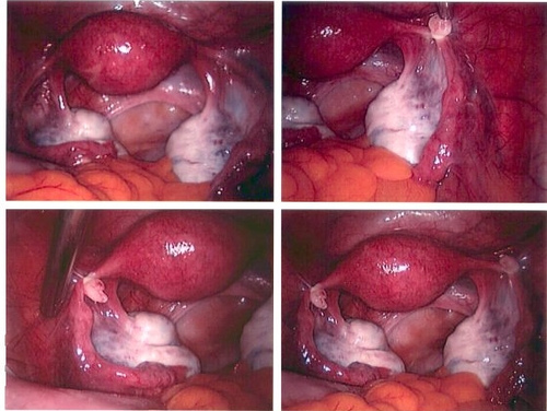 Endometriosis And Clomid