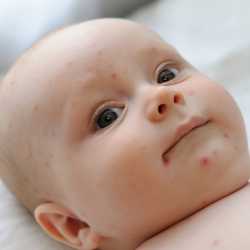 Bebés con varicela