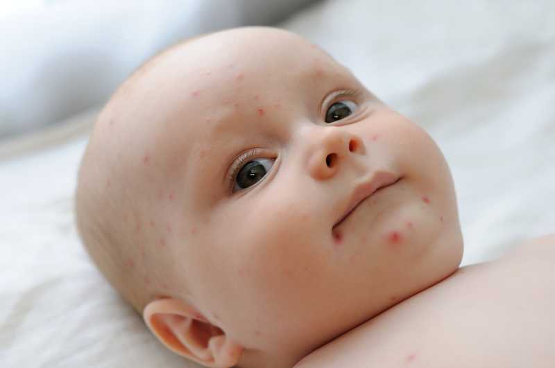 Bebés con varicela