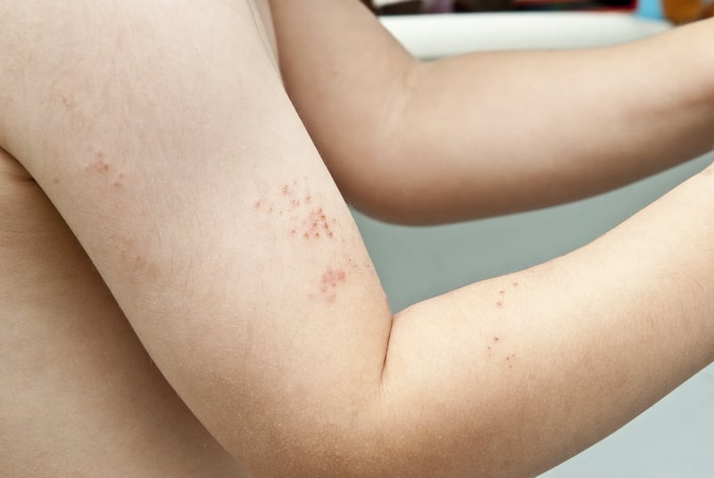 Herpes infantil en niños y bebés