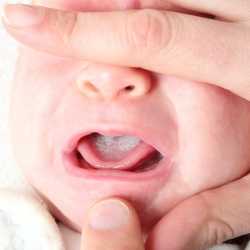 Candidiasis: infección en la boca de bebés y niños