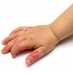 Bebés con asaduras o eczemas