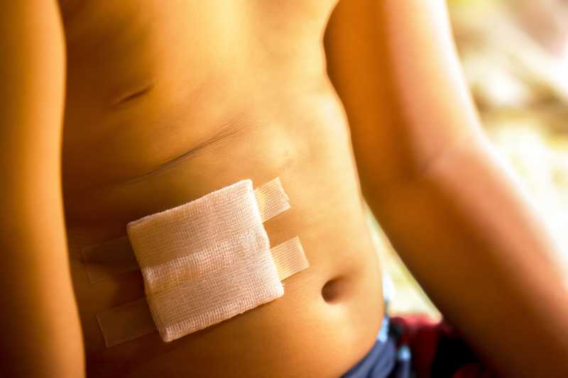 images Heridas Mujer Puntos En La Cabeza una herida necesita puntos de sutura