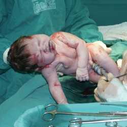 El parto por cesárea o parto abdominal
