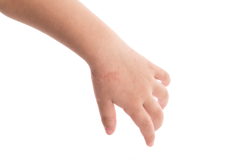 Psoriasis infantil en niños y bebés