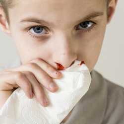 Cómo detener una hemorragia a un niño