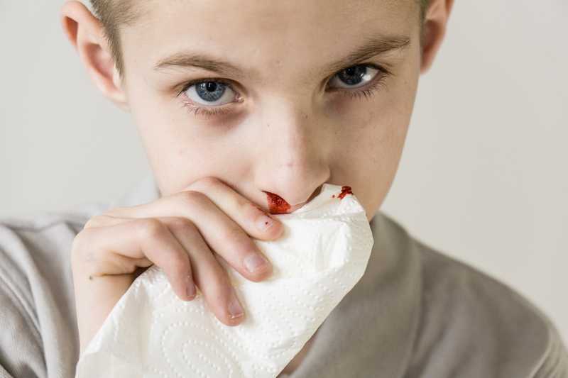 Cómo detener una hemorragia a un niño